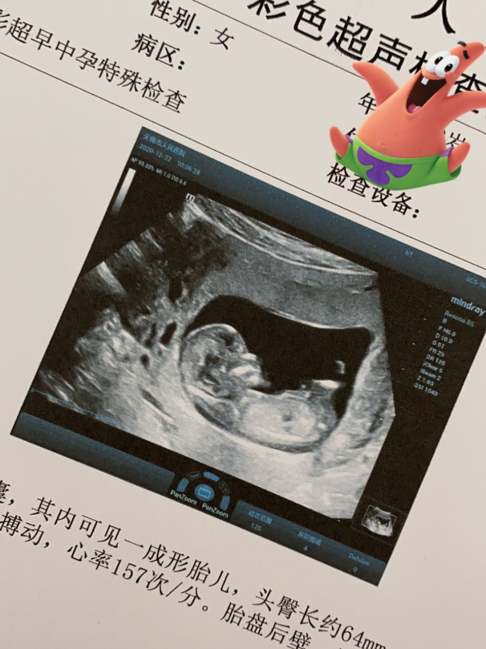 12周 2去做的nt,一开始小可爱还不太配合.