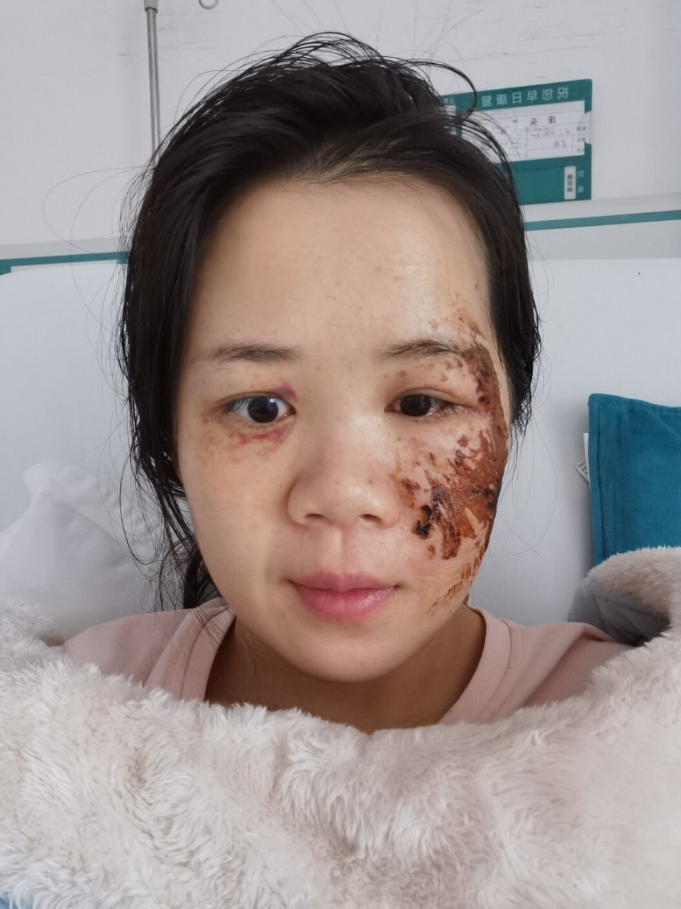 脸部擦伤第10,11天 前两天涂碘伏的次数减少,会涂抹山茶油,并且会用