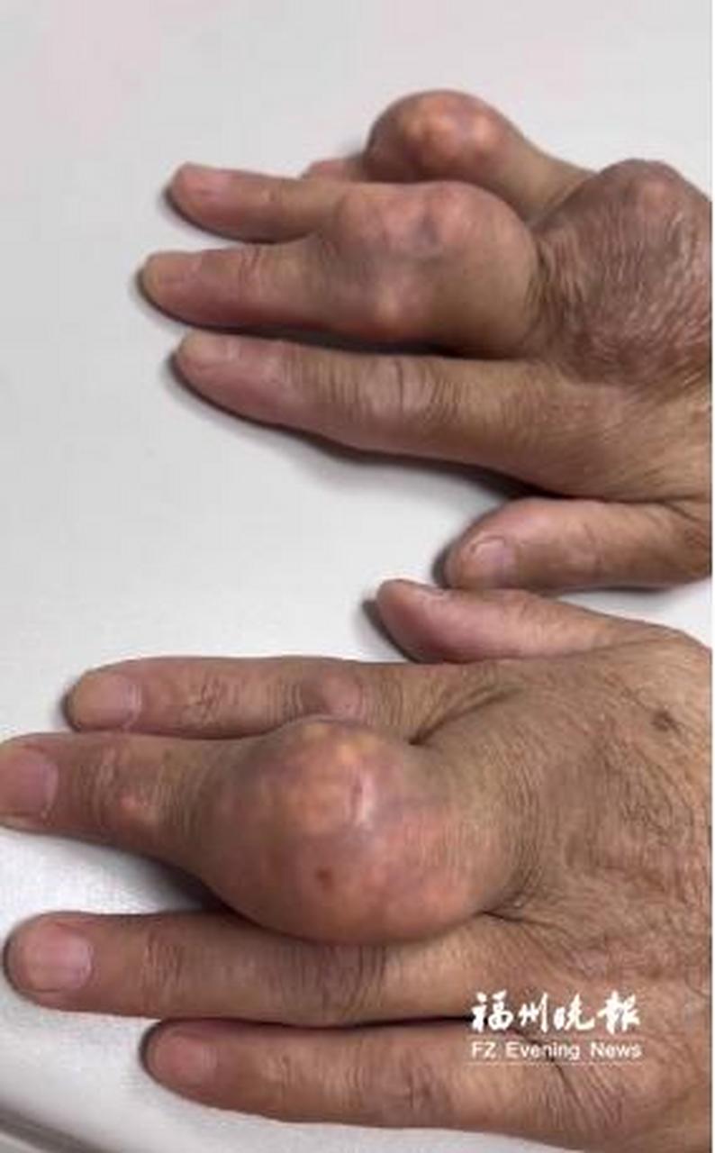 【爱吃海鲜配啤酒 福州一男子痛风发作手上长满"石疙瘩"】炎炎夏日
