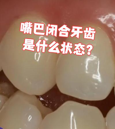 嘴巴自然闭合时,牙齿的正常状态是上下牙的牙合面尖窝交叉相对,形成