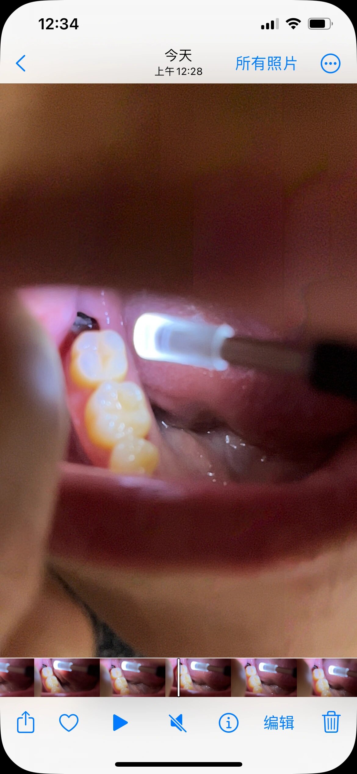 如果最里面深色的是血凝块的话,那这上面的浅色是什么呀?