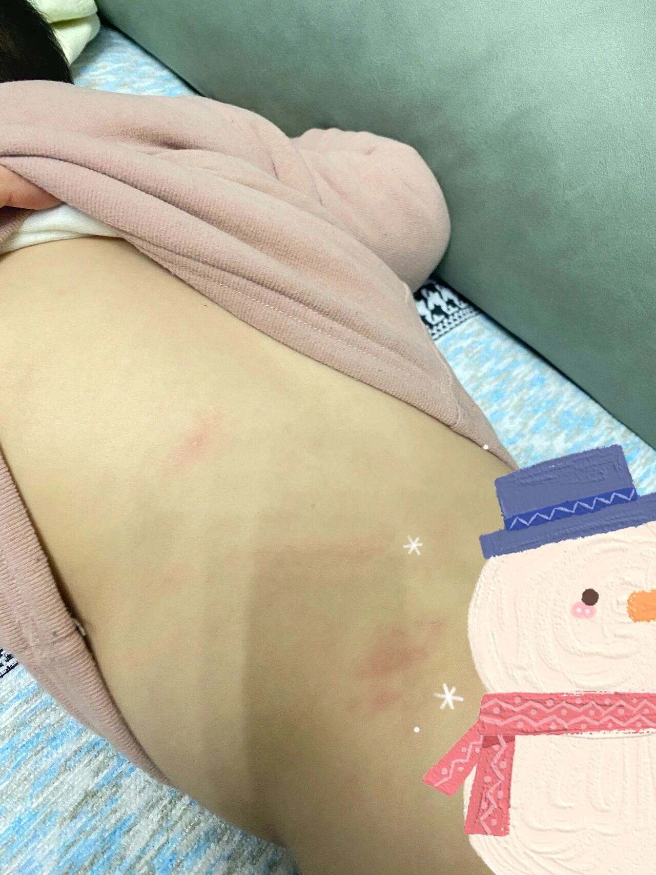 孩子肚子上和后背上有几个这样的小红疙瘩,一挠就变红,有姐妹知道这是