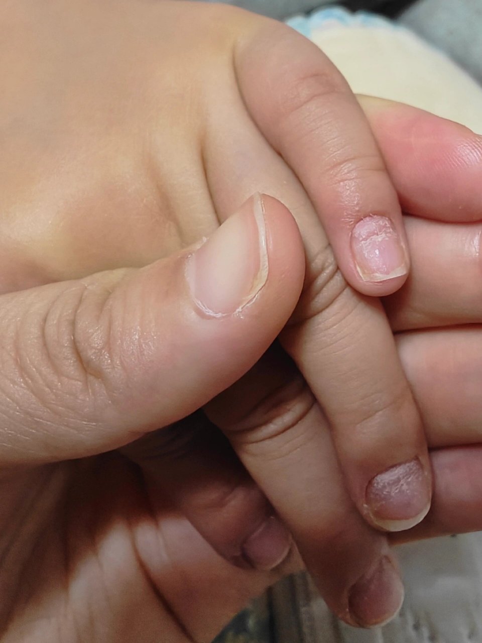 6岁小朋友指甲为什么这样 大概几个月前发现女儿有一两个指甲有凹凸