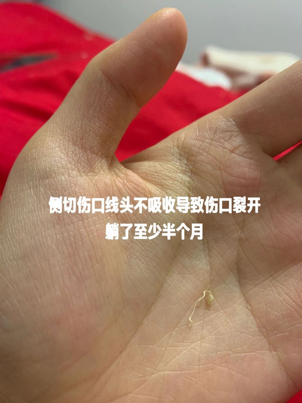 产后10天侧切伤口裂开分享我的恢复过程 我是顺产,撕裂加侧切,住院