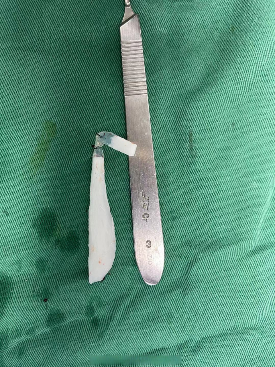 刚取出的l型硅胶假体,直接接触的皮肤黏膜,鼻尖无任何保护[作揖] 取出