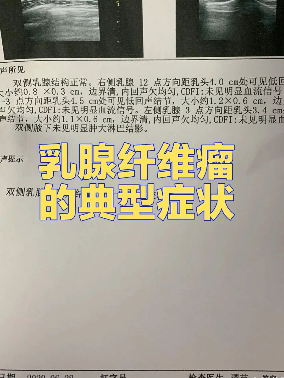 乳腺纤维瘤的典型症状 乳腺纤维腺瘤有哪些典型症状?