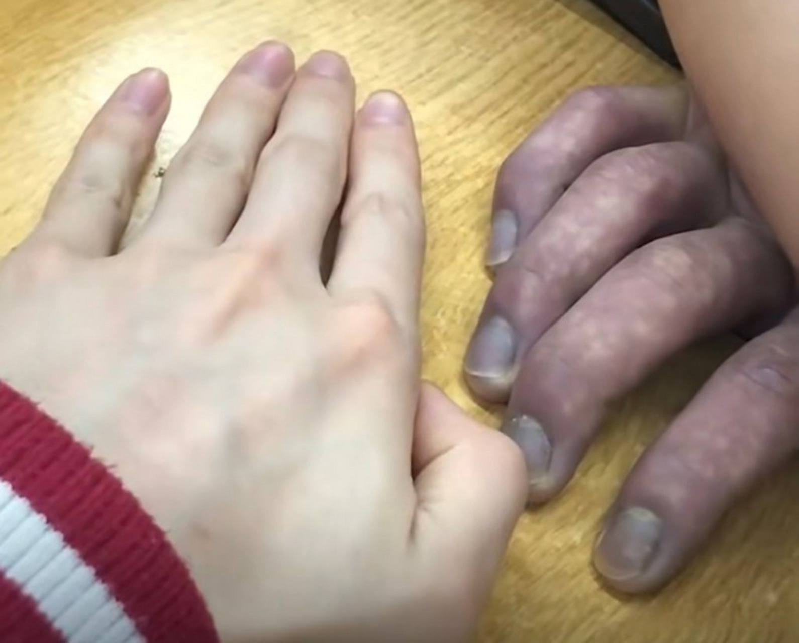 学生趴睡手指压出淤血变紫#手紫成这样了,再不解除压迫指头要发生