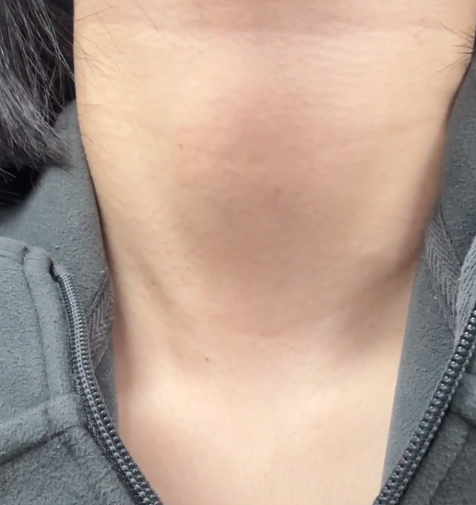 甲状腺肿大可以自己在家用双手简单检查