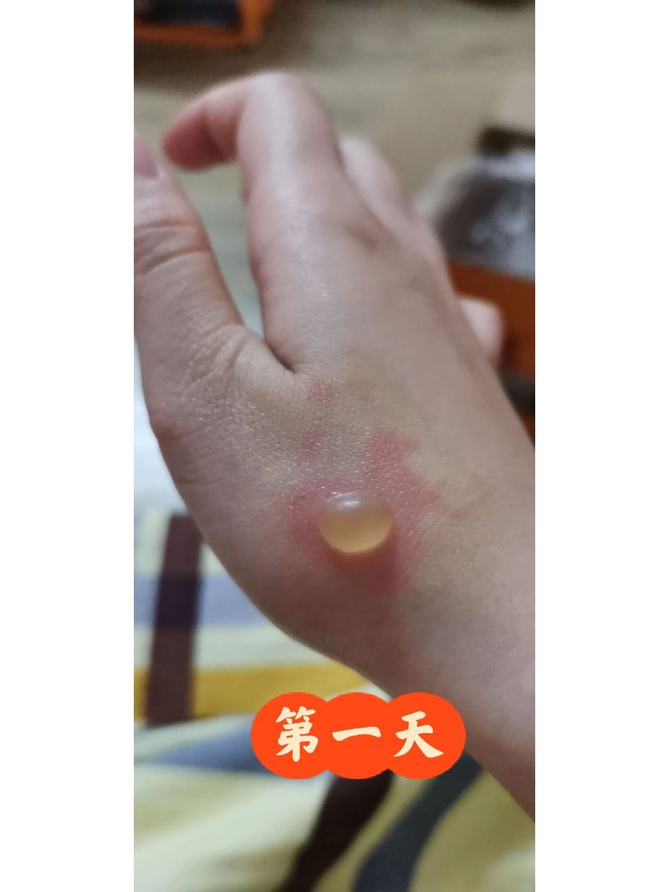 烫伤水泡 晚上抱着热水袋睡觉,本来是隔着一层被子抱,睡太香了,不知道