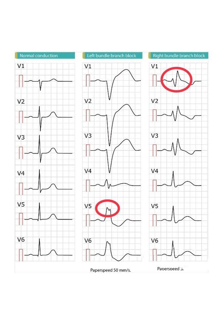 心内提问|完全性右束支传导阻滞怎么看?