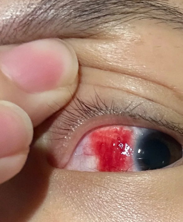 眼睛充血越来越红,常见原因包括外伤,视疲劳,角膜炎或结膜炎