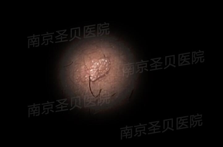 阴囊上长菜花状图片