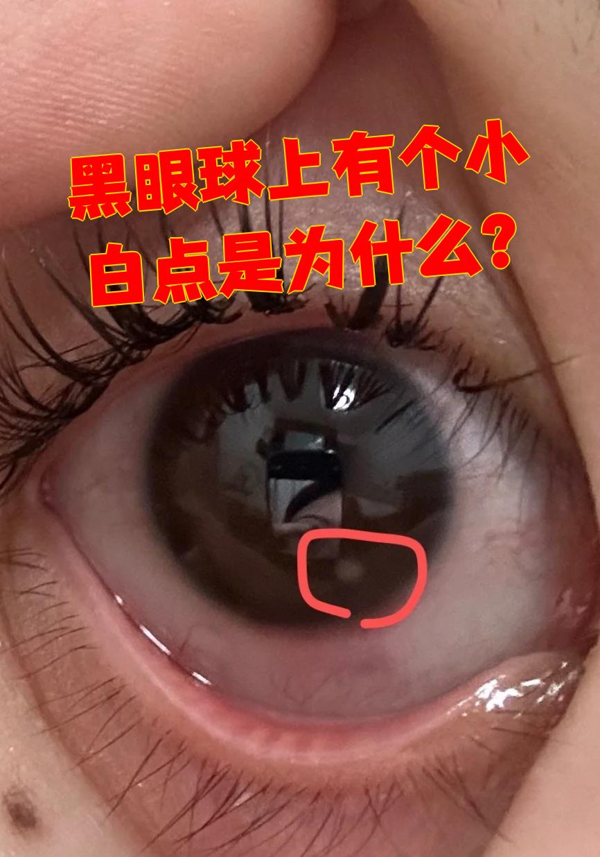 黑眼球上出现小白点可能和角膜瘢痕,白内障,翼状胬肉这些疾病有关