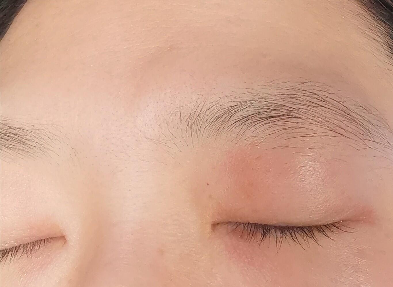 【过敏】眼皮发红发痒 最近半年,基本上每个月一次,左眼皮痒,越抓越痒