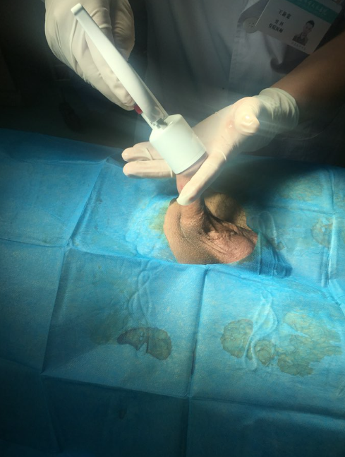 儿童包茎是指包皮过长完全盖住龟头,导致龟头露不出来