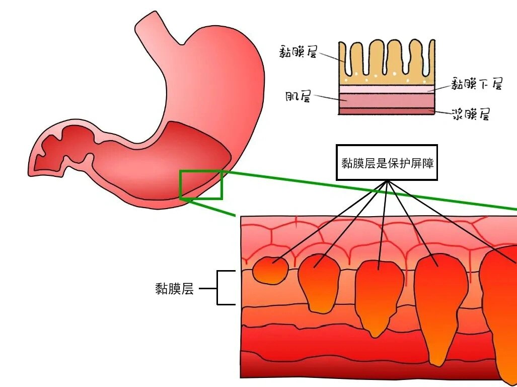胃黏膜太薄