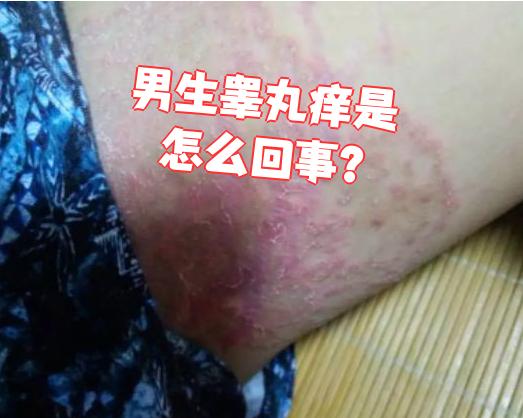 如果平时不注意清洁,内裤更换不勤,汗液和细菌可能刺激皮肤,导致瘙痒