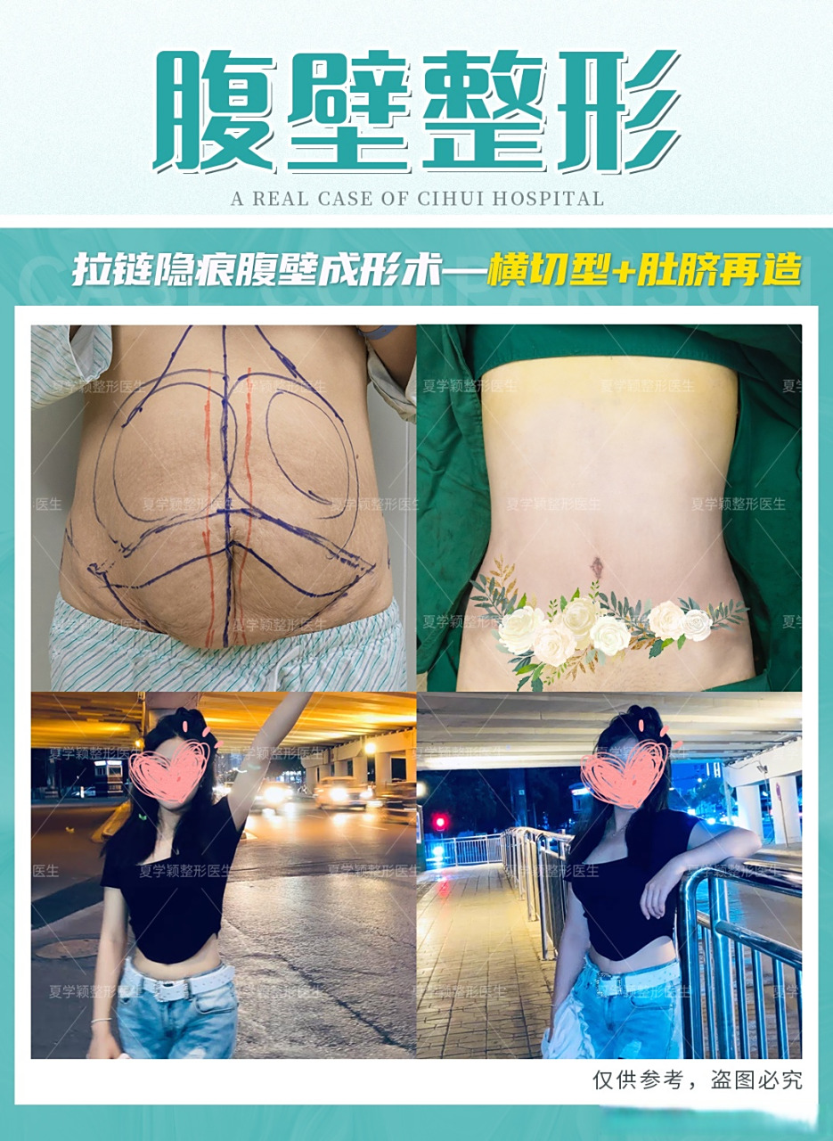 腹壁整形术恢复后对比#腹壁整形# #多点提升元气立现