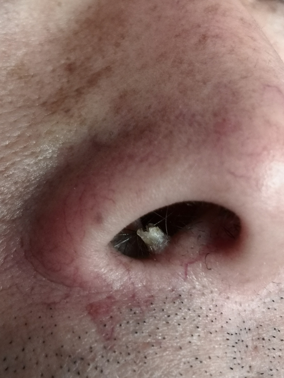 鼻孔内的寻常疣症状.激光治疗去除前后即刻对比图.#寻常疣##激光