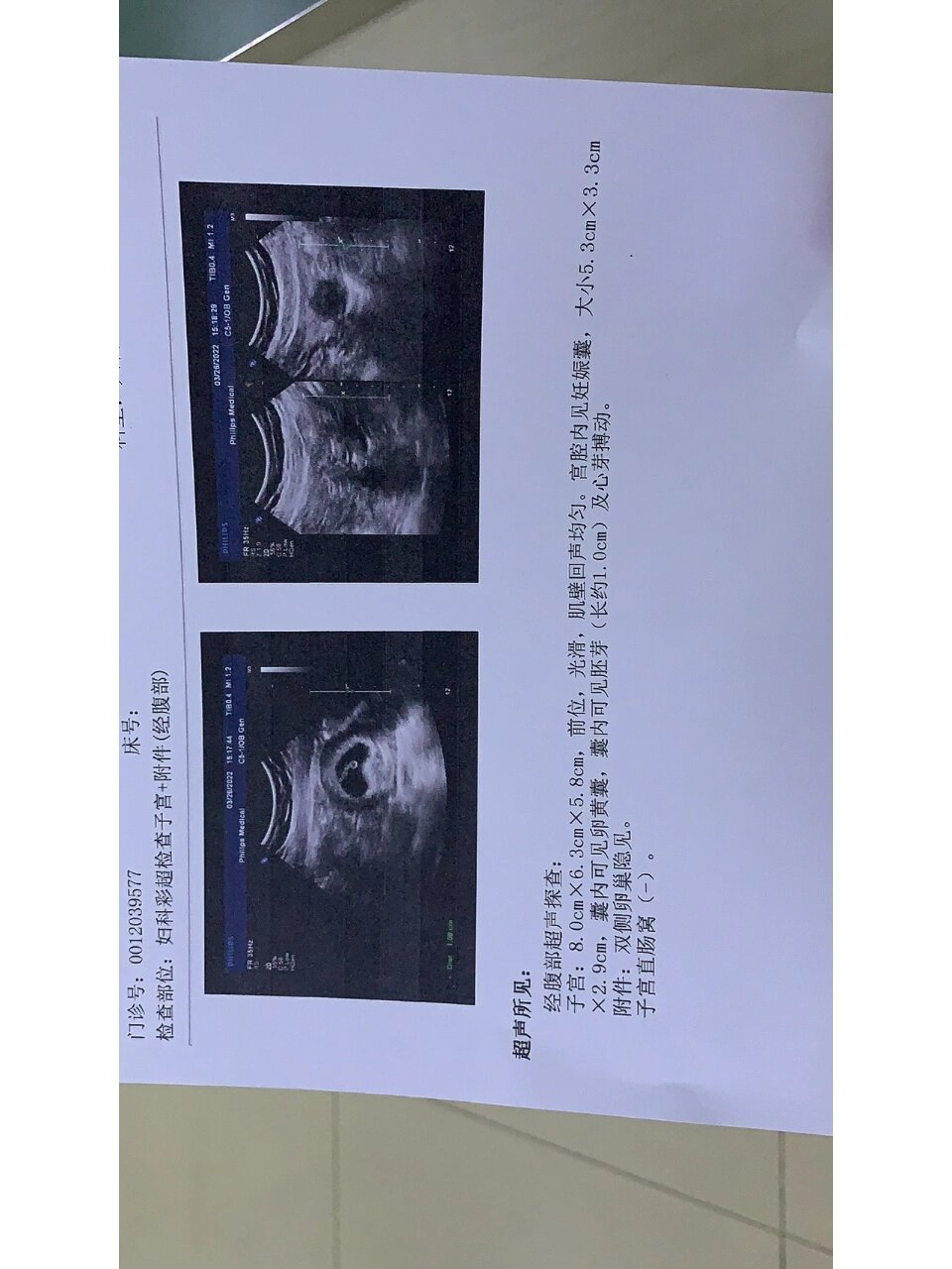 孕囊妥妥的茄子型,都说茄子形状男孩几率大,已检查,女孩97,小公主