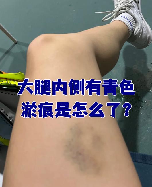 大腿内侧出现青色淤痕常见原因包括外伤,过敏性紫癜,系统性红斑狼疮