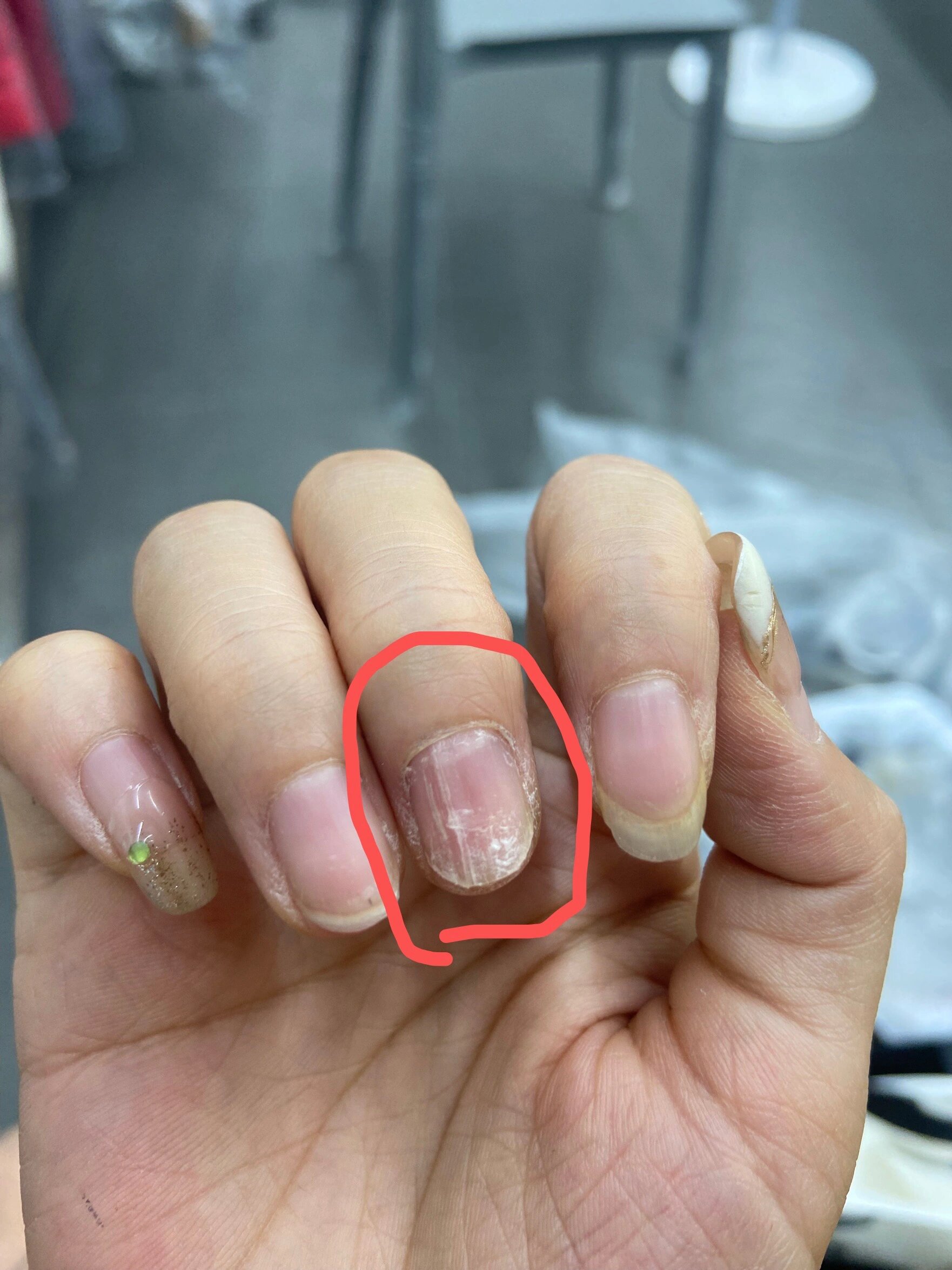 导致指甲生病 整片坏掉就脱落了 ,现在指甲长出来凹凸不平 甲片也很丑