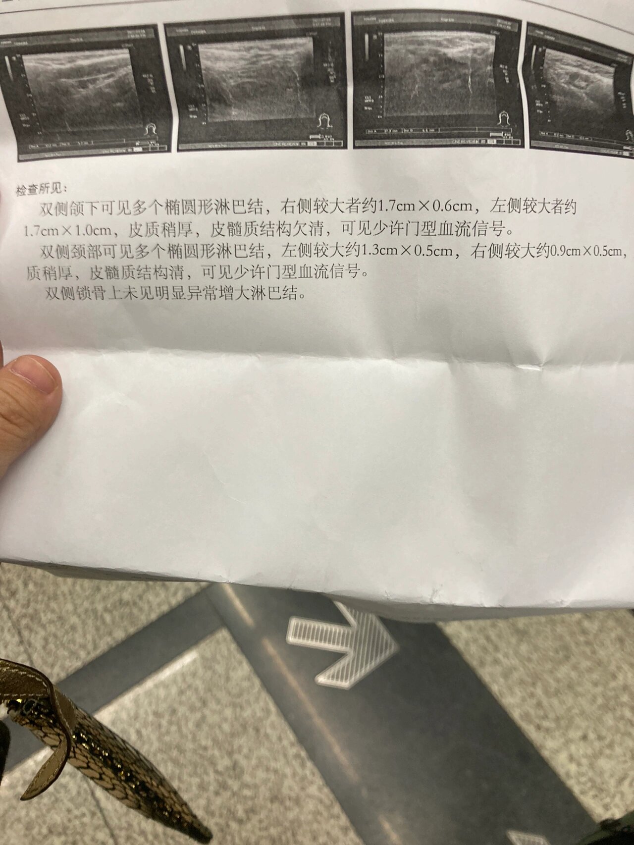 下颌淋巴结皮髓欠清(后续已发) 好了兄弟们,现在换我来求助大家,换