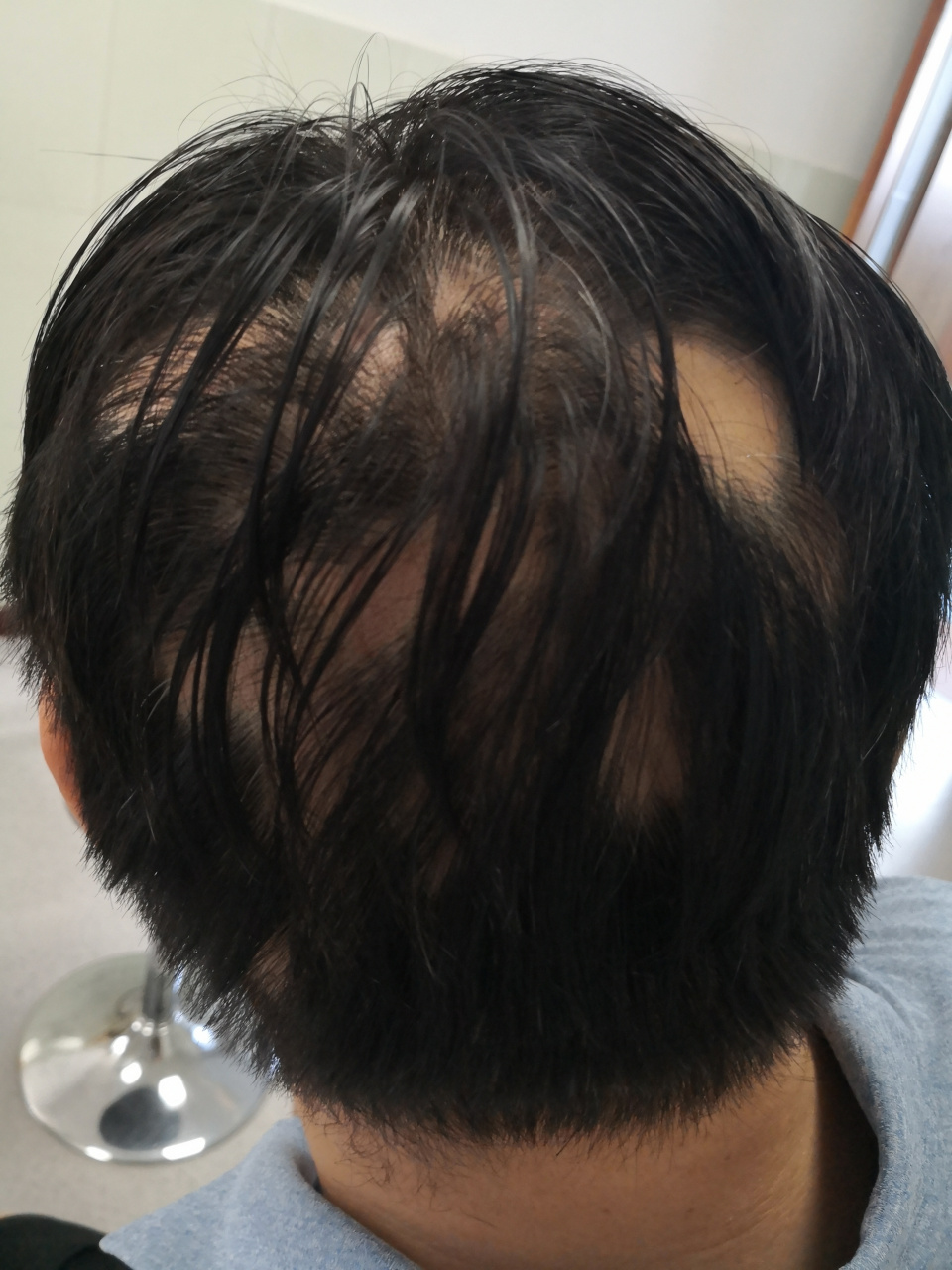 斑秃症状#脱发##免疫##解决皮肤问题专注皮肤美容