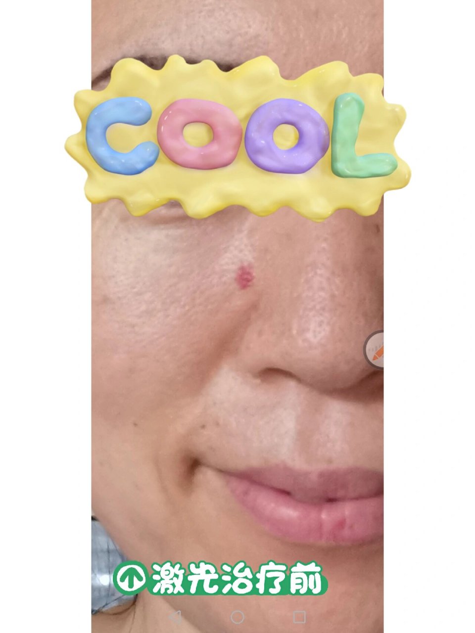 血管瘤激光治疗 这个红色印记跟随我好几年了,昨天去皮肤病医院,做了