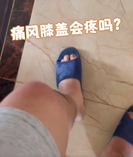 痛风膝盖会疼吗?