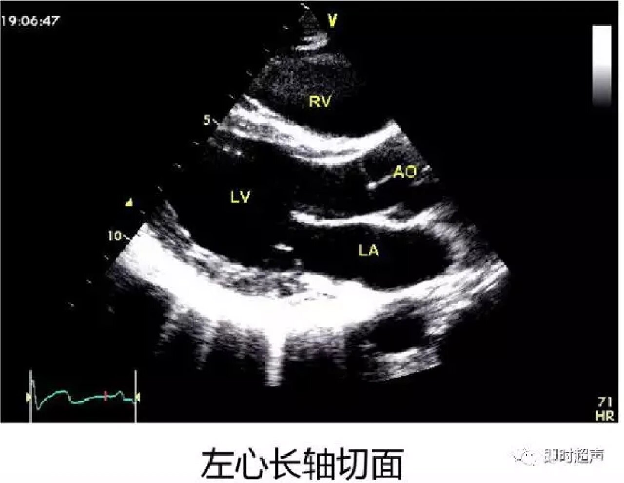 心脏超声八个标准切面图片