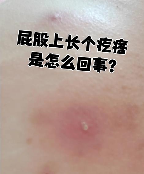 屁股上长个疙瘩是怎么回事?