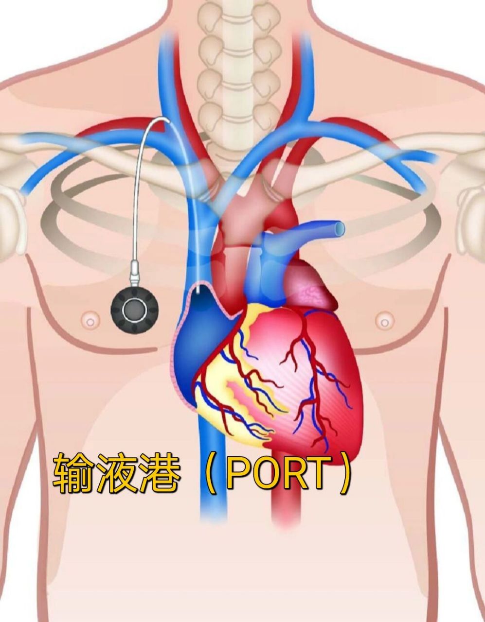 输液港装置图片图片