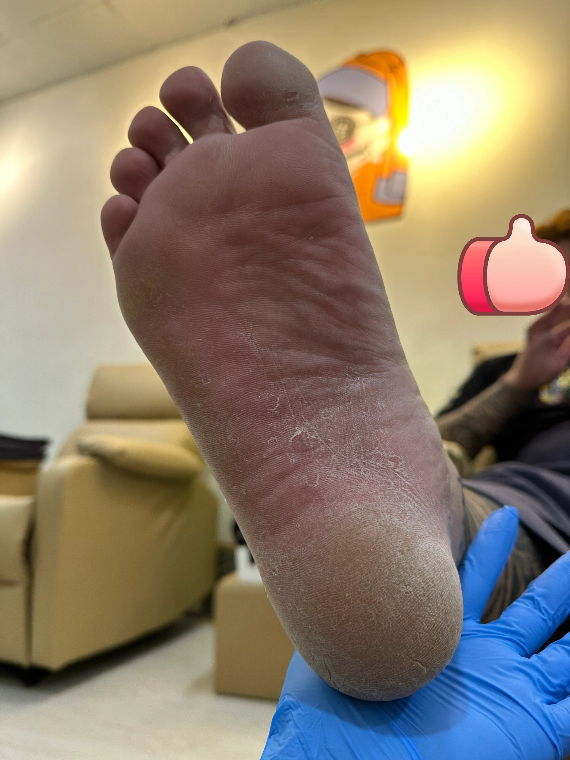 顾客脚底板的死皮硬茧特厚🥹🥹