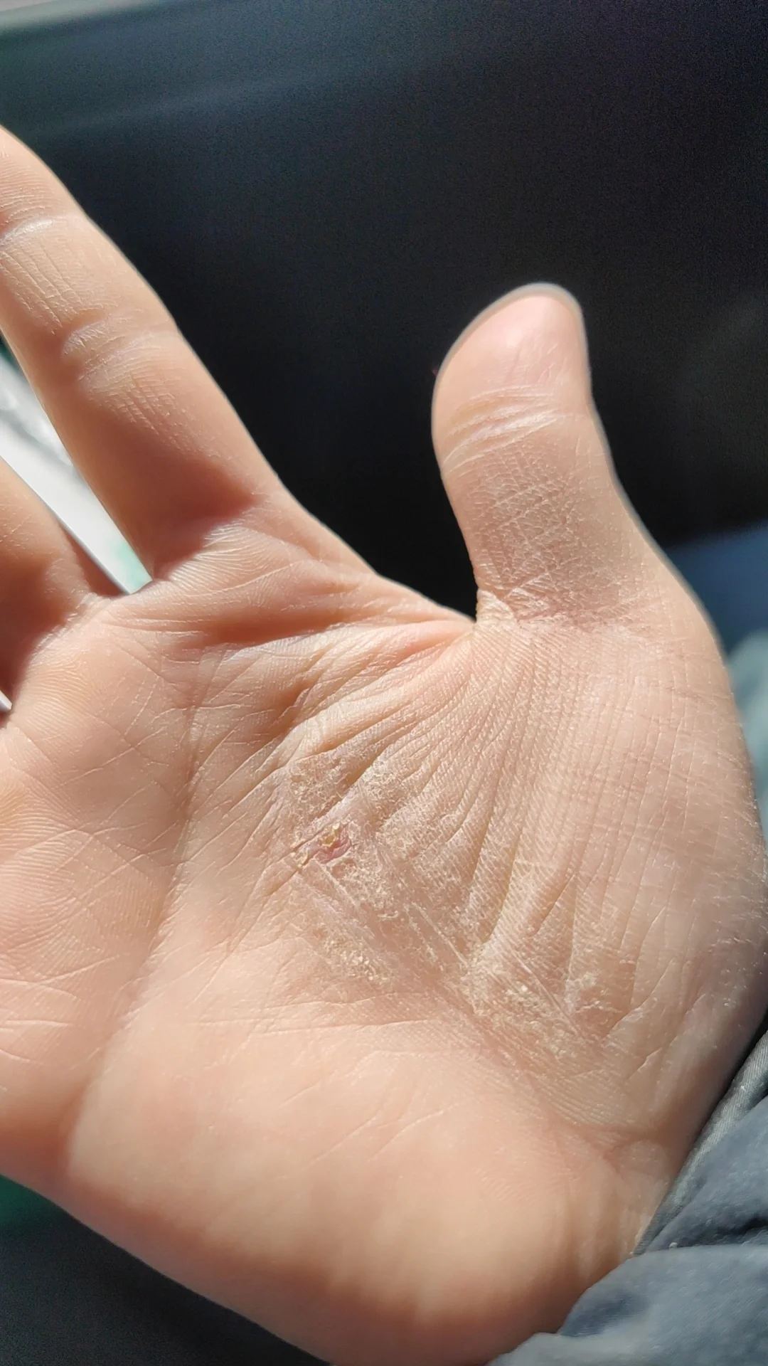 手心特别痒是什么情况!