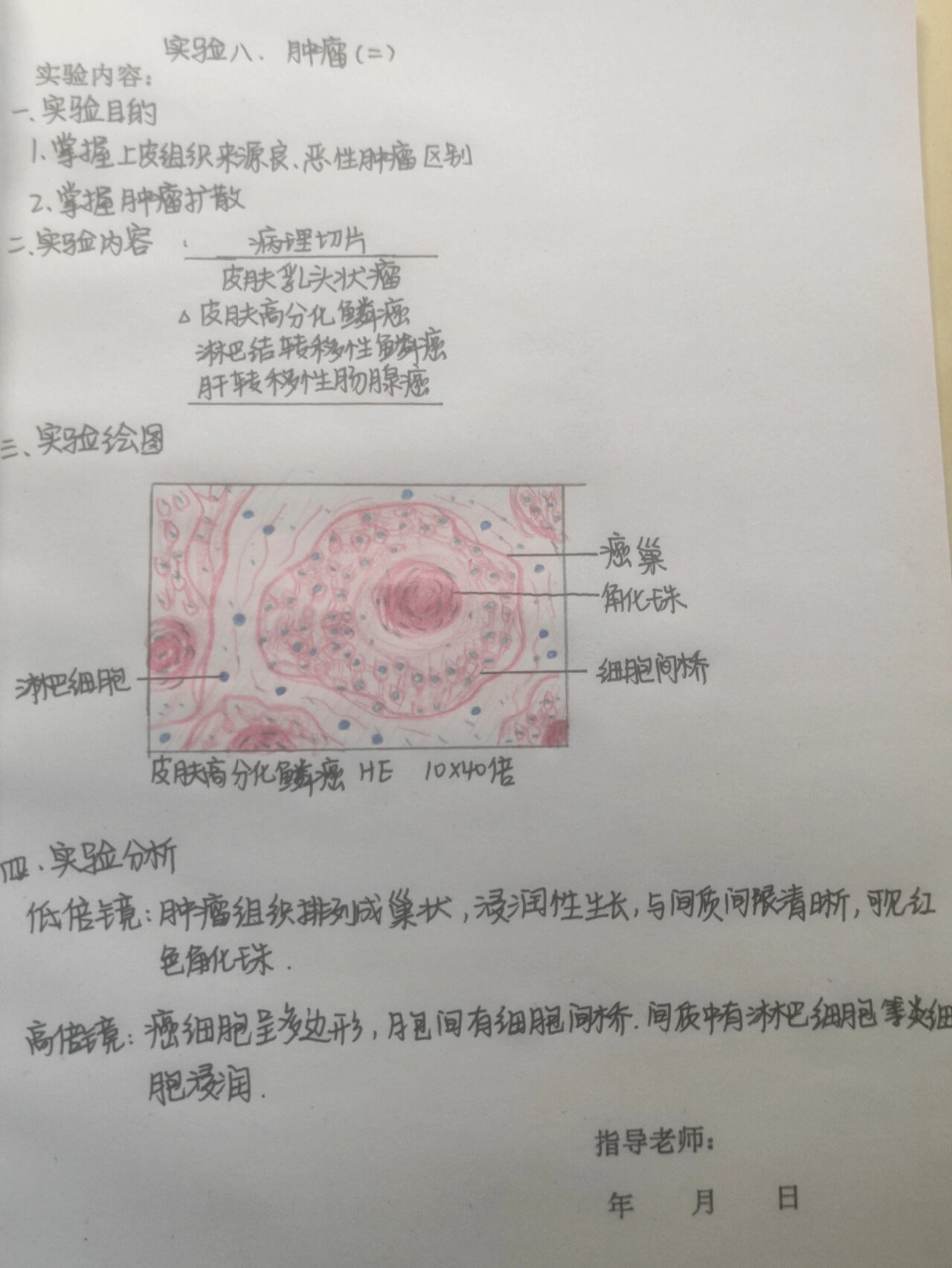 肿瘤-皮肤高分化鳞癌 红蓝铅笔手绘 淋巴细胞 癌巢 角化