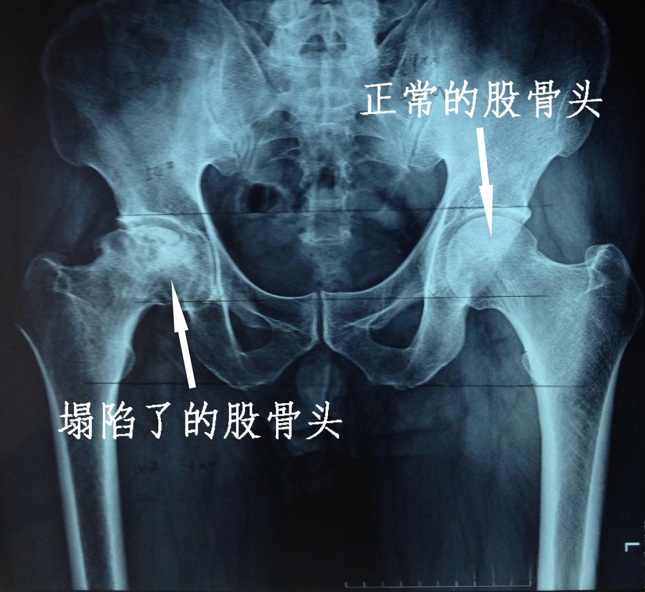 股骨头坏死疼痛!