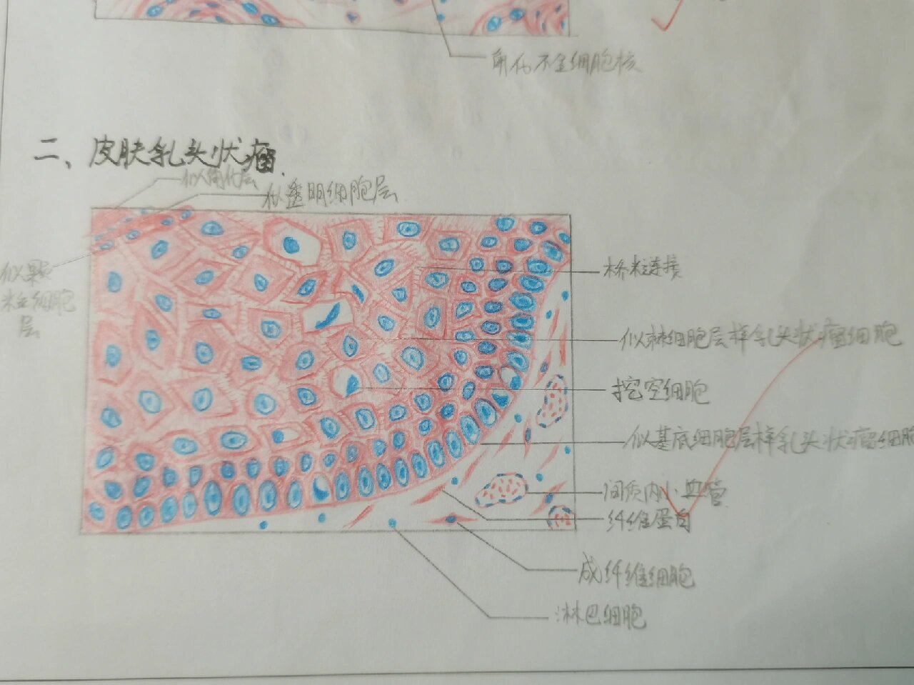 鳞状细胞癌绘图图片