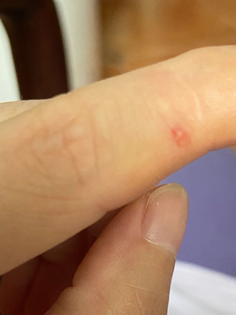 被仓鼠咬了一口