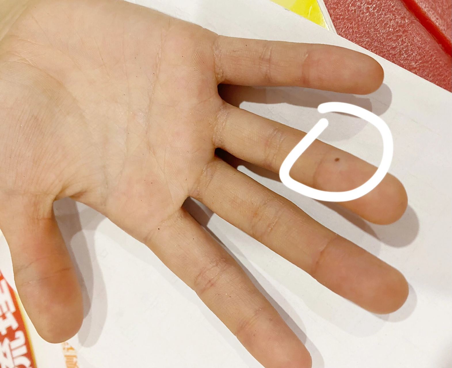 孩子手指上突然长了个黑点 不知道是怎么回事,有没有妈妈遇见过这种