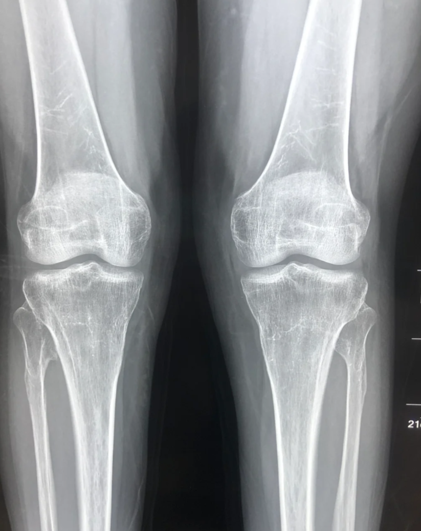 膝盖一动就咔咔响,这种情况挺常见的,可能和关节腔积液,剧烈运动