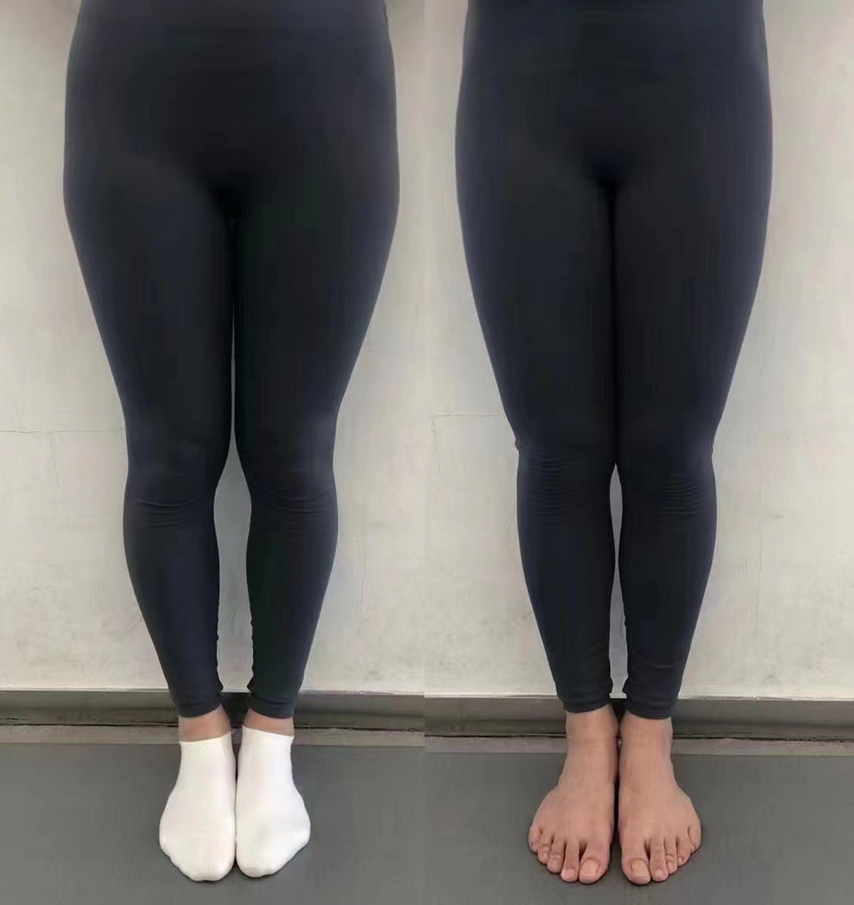 一次xo型腿矫正的效果 一次的效果#腿型矫正# #xo型腿# #改善腿型