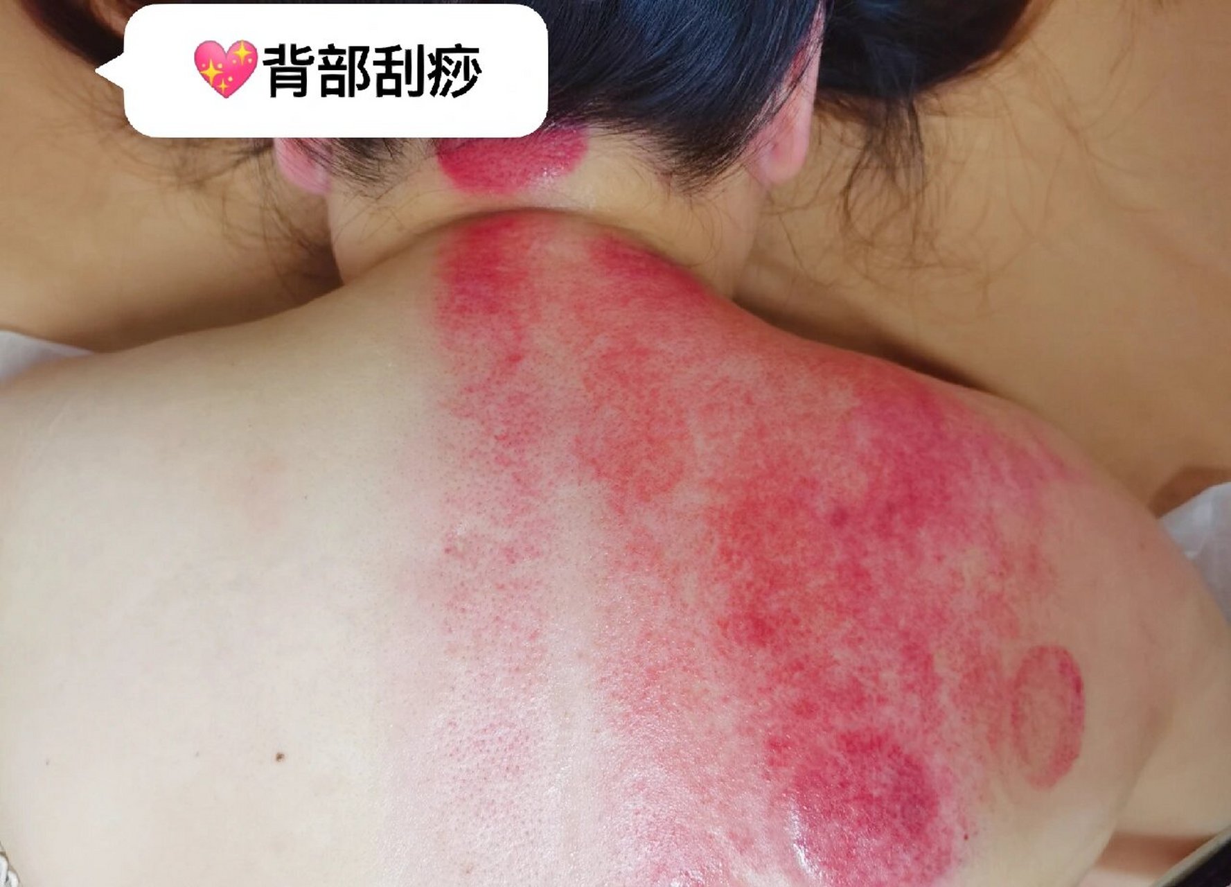 背部刮痧有活血化瘀,通经活络的作用,对背部紧张,劳损,以及背部肌肉