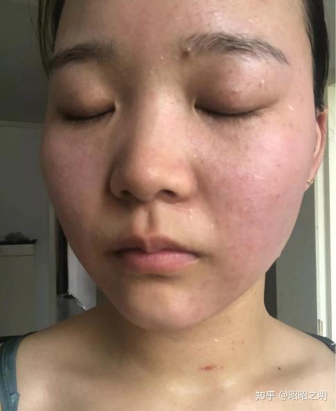 敏感肌护肤品照着买就行根源解决皮肤泛红干燥起皮舒缓镇定的绽妍修红