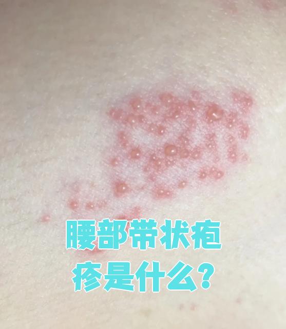 带状疱疹病毒引起的感染,这个病最麻烦的就是会