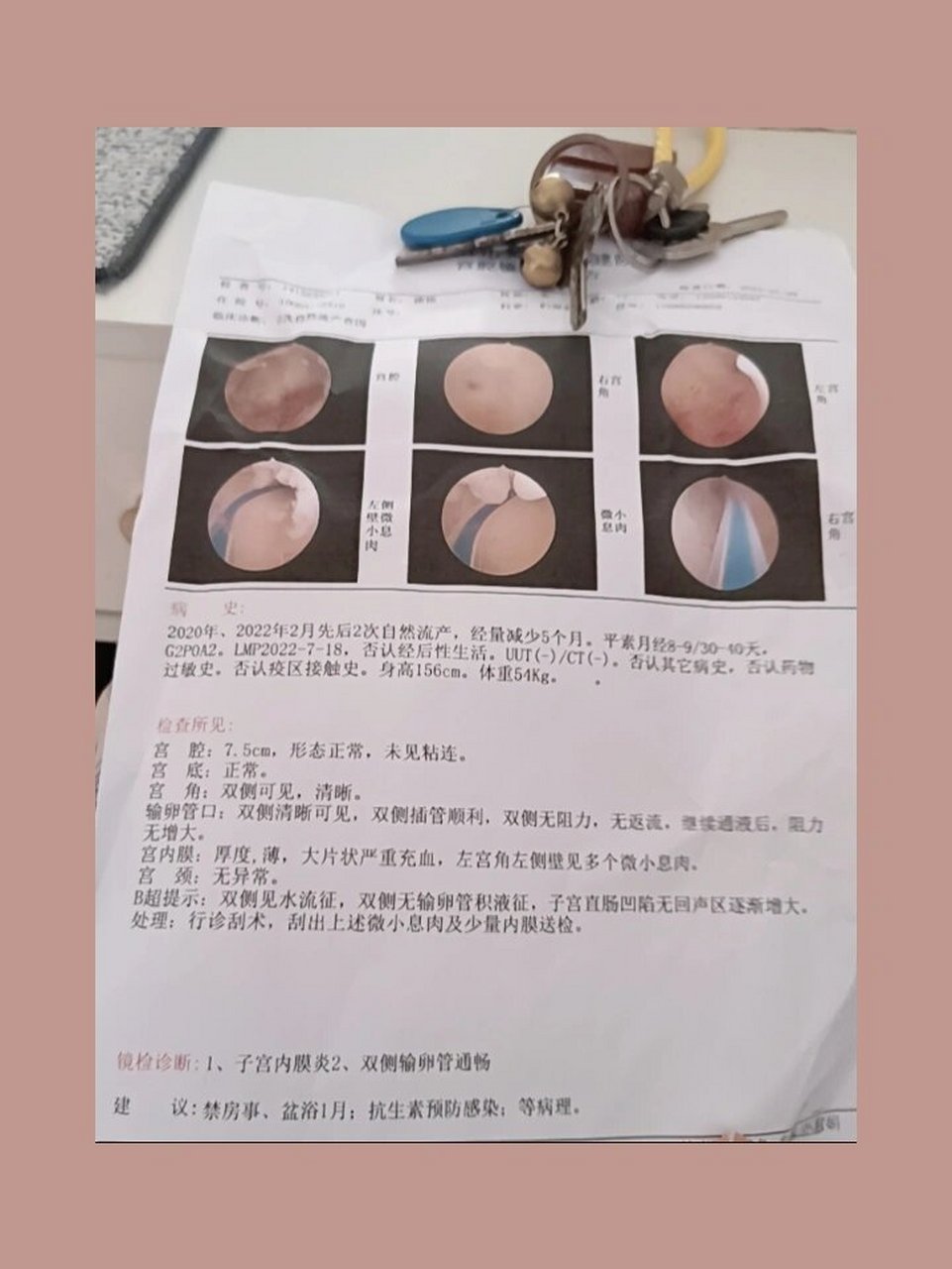 宫腔镜输卵管插管术 昨天做了宫腔镜检查,打麻药不疼,做完后大概三个