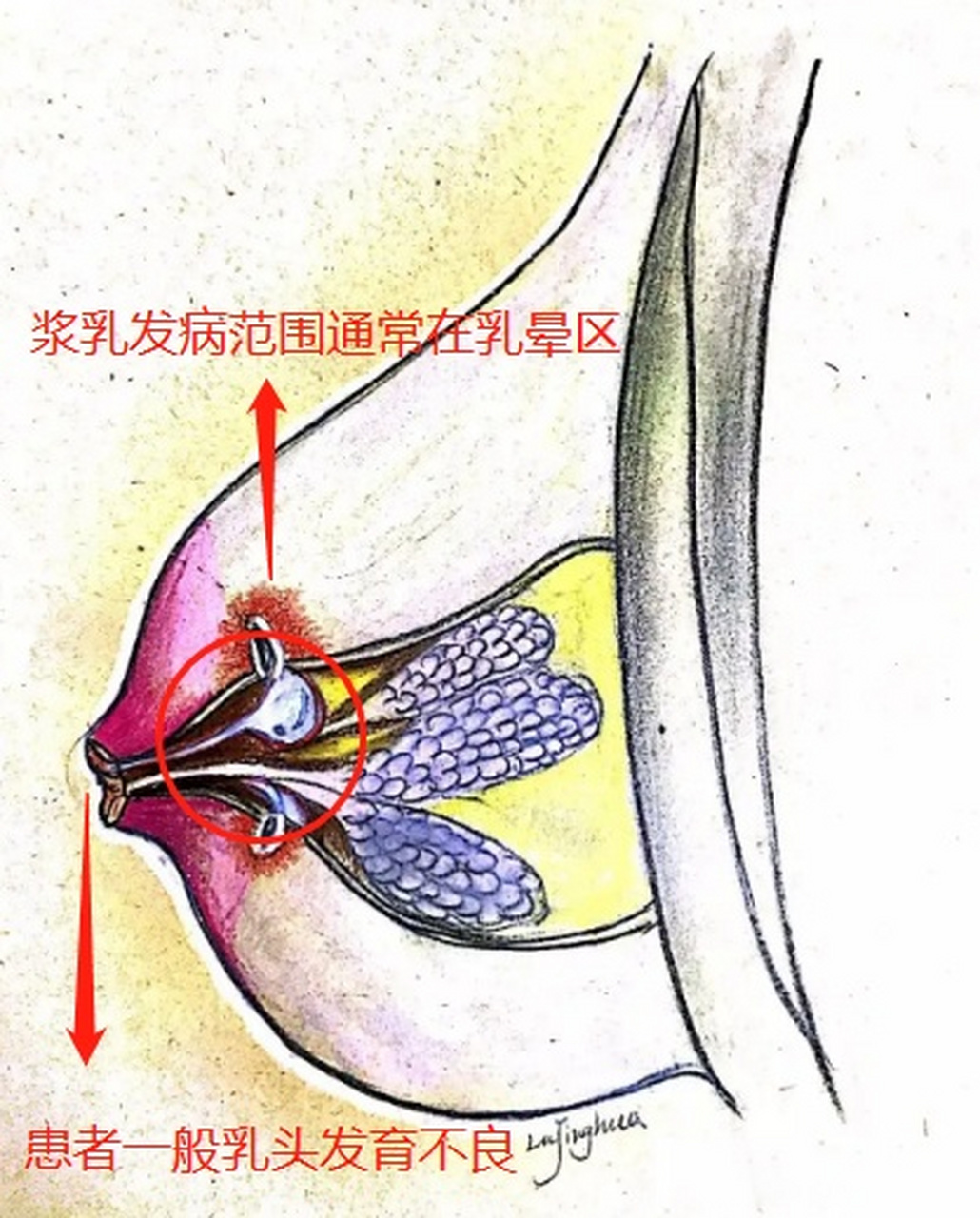 以下3点可能预示"不死乳癌"#浆细胞性乳腺炎# 找上门】[惊哭] 浆乳