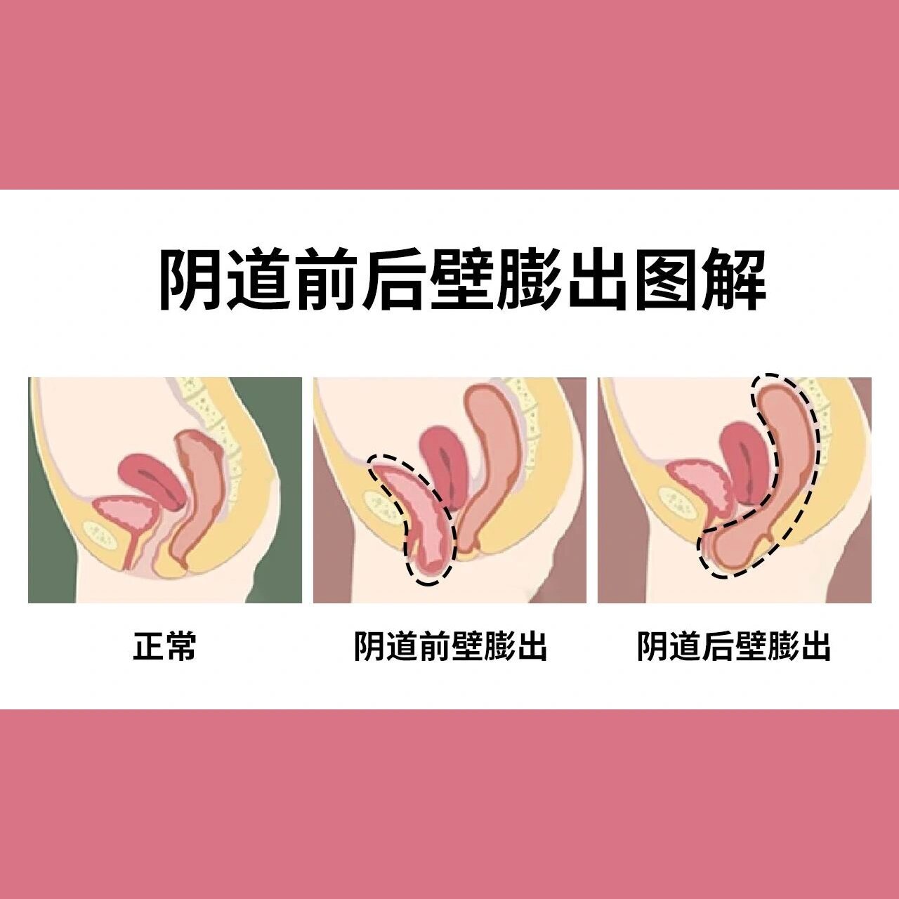 前后壁膨出原来是这样的!