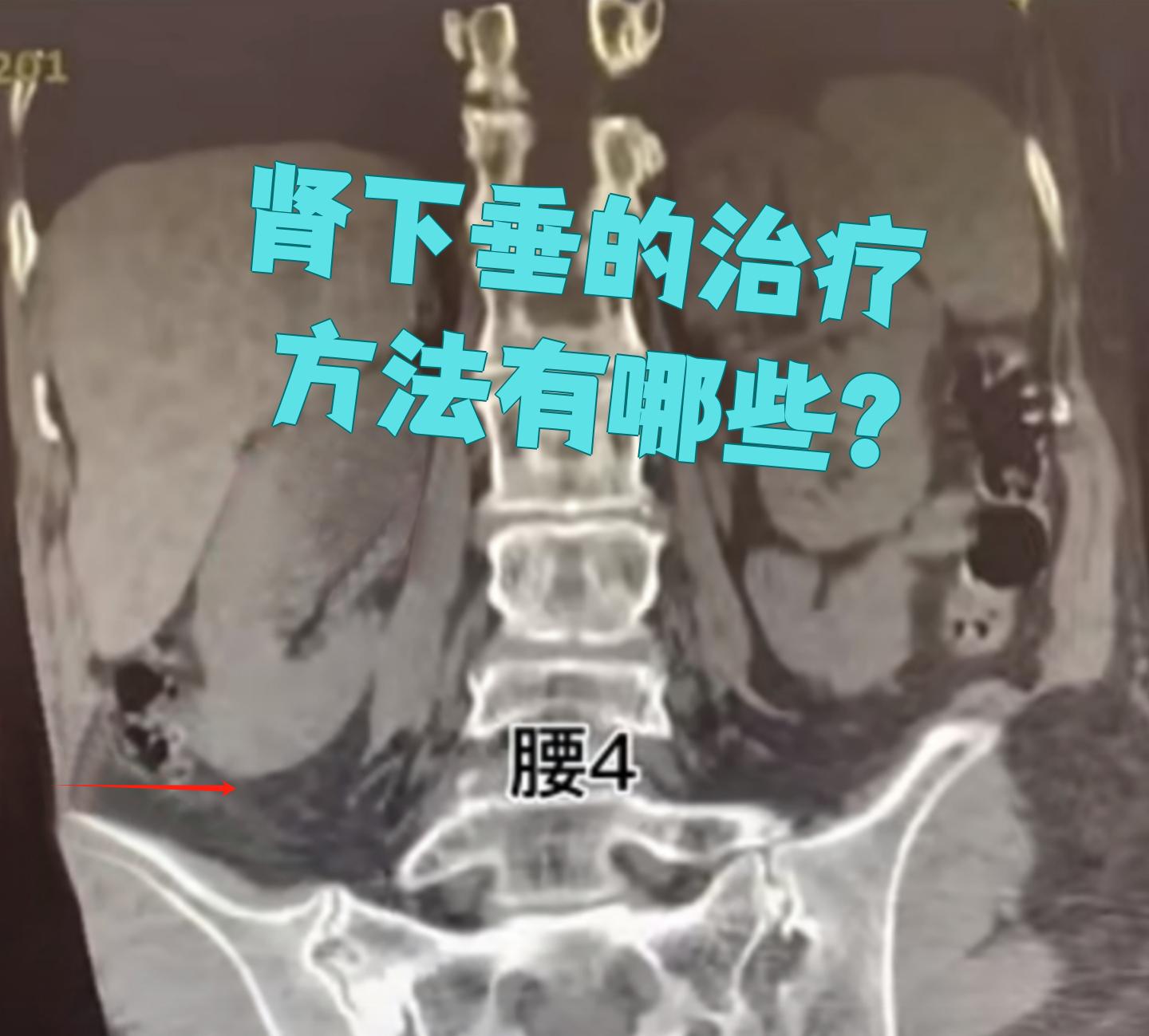 肾下垂的治疗方法有哪些?