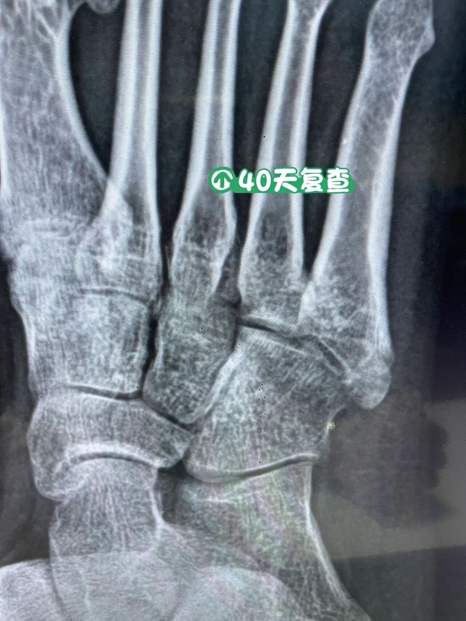 第五跖骨基底骨折40天复查 骨折40天了,还有一点缝,脱拐走路一星期